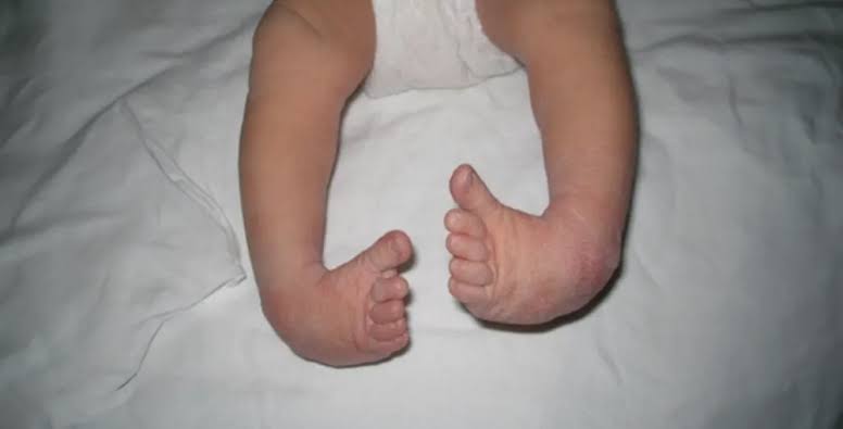Early Treatment Can Save Children With Clubfoot From Surgery — Surgeons